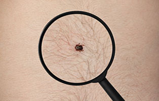 Long Island Tick Spraying