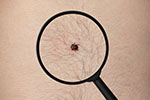 Long Island Tick & Mosquito Spraying